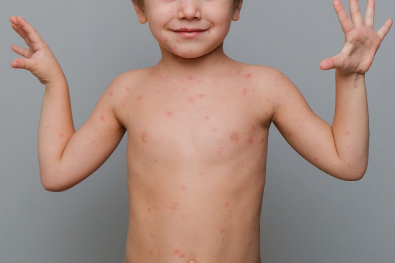 Photo d'un enfant présentant des boutons de varicelle rouges