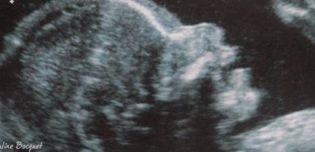 Bébé né avec une malformation passée inaperçue : les échographies